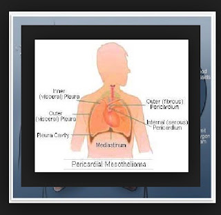 The Facts Nigh Pericardial Mesothelioma Image
