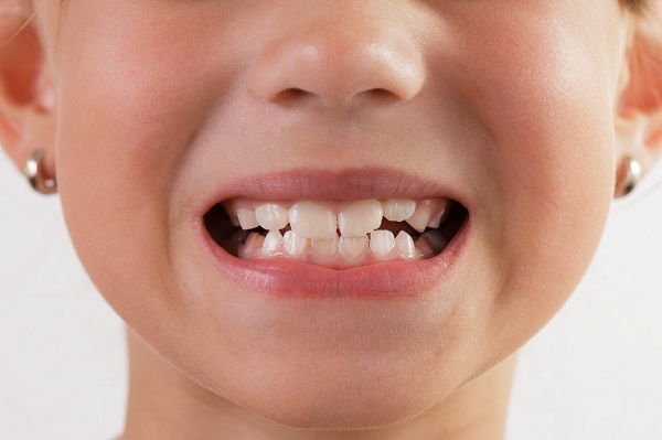 Những bệnh lý cơ thể có thể là nguyên nhân khiến hàm răng của trẻ mọc sai lệch