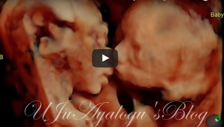Mother SHOCKED As Ultrasound Scan Shows Twins Kissing In Her Womb ..Watch The Video Here Ultrasound Scan Shows Twins Kissing In Her Womb