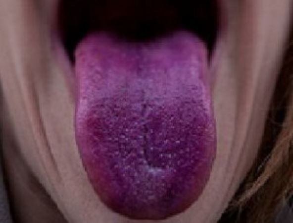 The appearance of your tongue has something to say about your health!