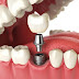 Trồng răng implant không nên áp dụng cho những ai?