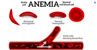  10 Best diet for anemia patients