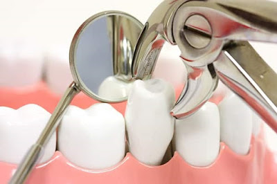 Vì sao phải nhổ 4 răng để niềng răng?-1 Vì sao phải nhổ 4 răng để niềng răng?-1