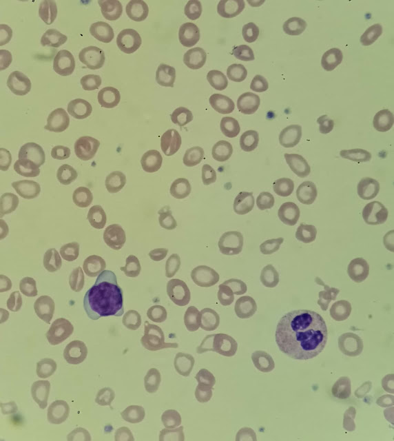 Faber's anaemia