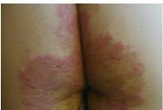 Obat gatal-gatal pada kulit pantat cepat sembuh