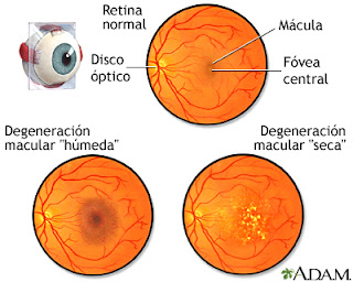 Degeneración Macular Asociada a la Edad 