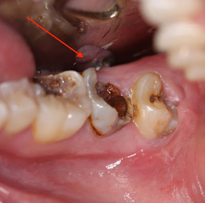 Trả lời nhổ răng cấm hàm dưới có ảnh hưởng gì không-2