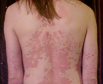 Psoriasis-treatment-remedies-prevention-Hindi
