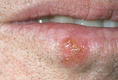 Bệnh lở miệng  ( Cold Sores )