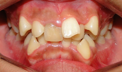 Răng khấp khểnh là gì? 