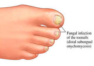 The 30-Second Trick for Best Cure For Nail Fungus 