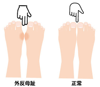 外反母趾の症状の有無をチェックする方法。詳細は後述。