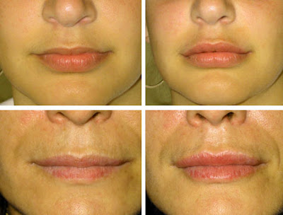 Lip Augmentation Before And After. Before choosing such injectibles discuss 