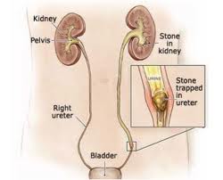 cara menghancurkan batu ginjal tanpa operasi,obat batu ginjal,obat kencing batu,cara mengeluarkan batu ginjal tanpa operasi,cara menghilangkan batu ginjal tanpa operasi
