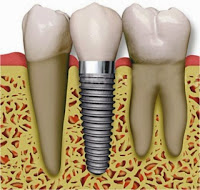http://www.dental-clinic-delhi.com/root-canal-treatment.html