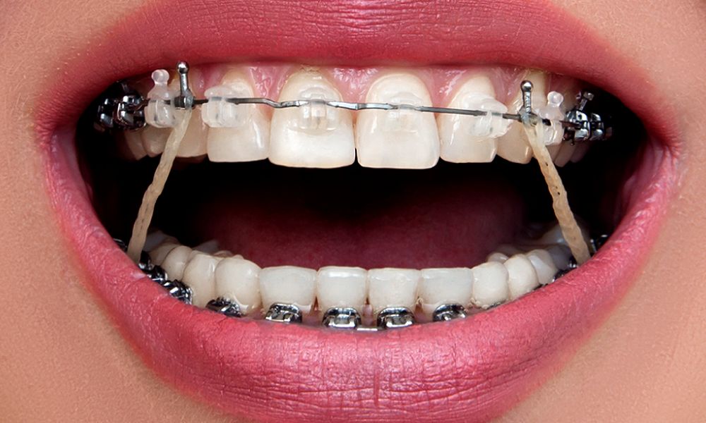 Orthodontic