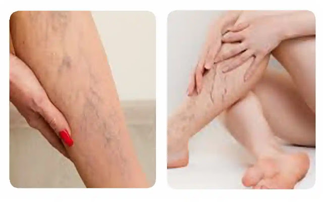 Unleashing the Varicose Vein Chronicles A Guide to Conversations with Your Doctor