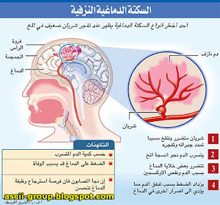 أربع مسببات للسكتة الدماغية عند الرجال The causes of stroke in men