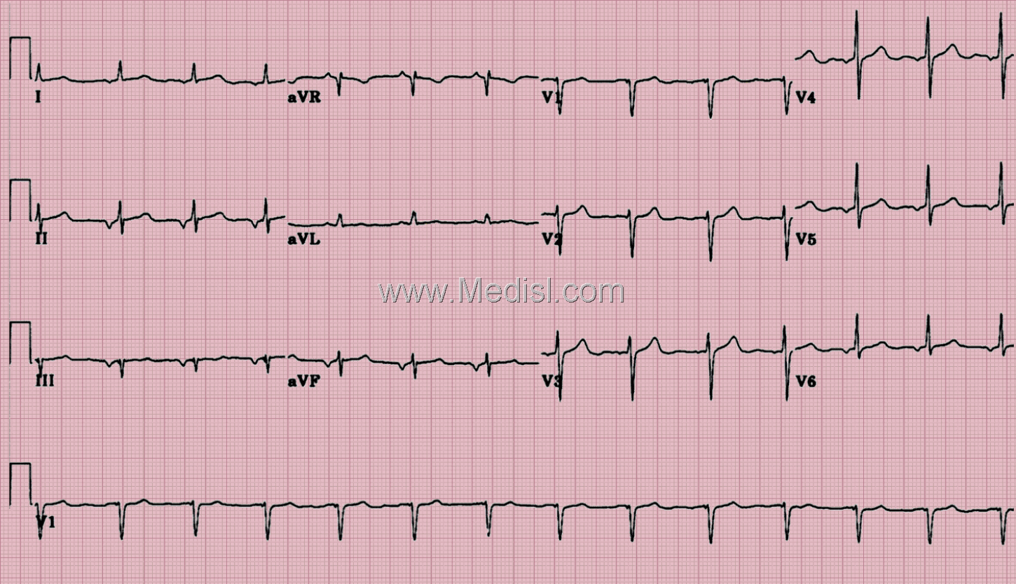 Fifty-four year old woman with a history of metastatic malignant melanoma who is being evaluated for a subsequent course of chemotherapy. Her past cardiac history includes an angioplasty to the left circumflex coronary artery eight years priorto this tracing. She is currently asymptomatic. Her cardiac medications included diltiazem and aspirin.