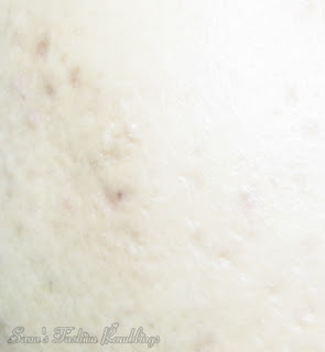 Acne Control : Ex-sufferer Reveals His Secrets