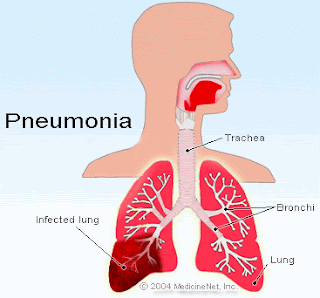 Pengertian, Gejala Gejala Faktor Penyebab dan Upaya Pencegahan Pneumonia