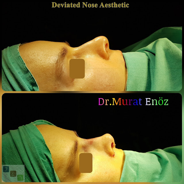 Deviated Nose Aesthetic Turkey