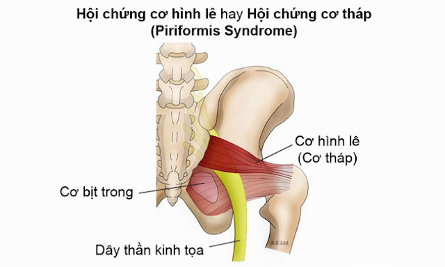 Hội chứng cơ quả lê là gì ?