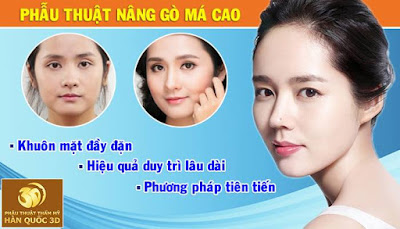 Phẫu thuật nâng gò má cao