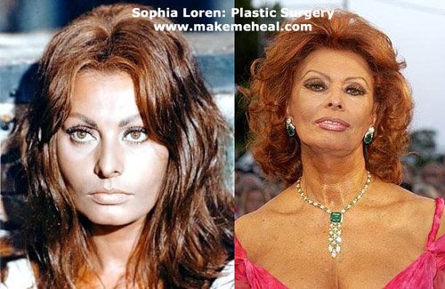 Sophia Loren Plastic Surgery
