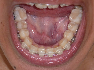 lower jaw, lower teeth, damon braces, damon clear braces, progress picture, photo, clear brackets, wires