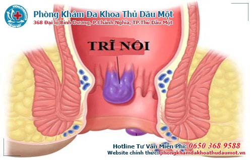 Hình ảnh bệnh trĩ nội