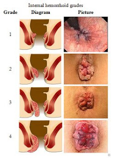 obat wasir alami dari tumbuhan