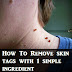 How To Remove Skin Tags With One Simple Ingredient