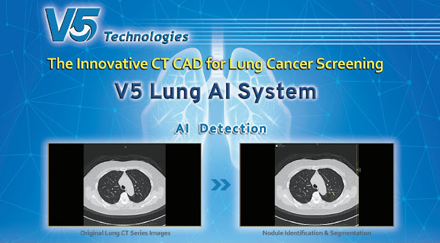 V5 technologies. The Innovative CT CAD for Lung Cancer Screening / alkes deteksi screening kanker paru berbasis AI jonadoctor health and business