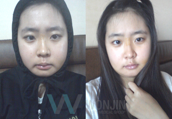 짱이뻐! - I just can’t wait to get this Korean Two Jaw Surgery