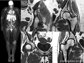 FDG PET and MRI of a patient with sarcoidosis and fat-containing bone lesions.