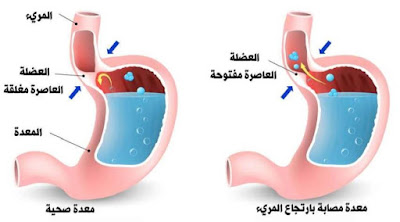 ارتجاع المرئ اسبابه واعراضه وطرق علاجه