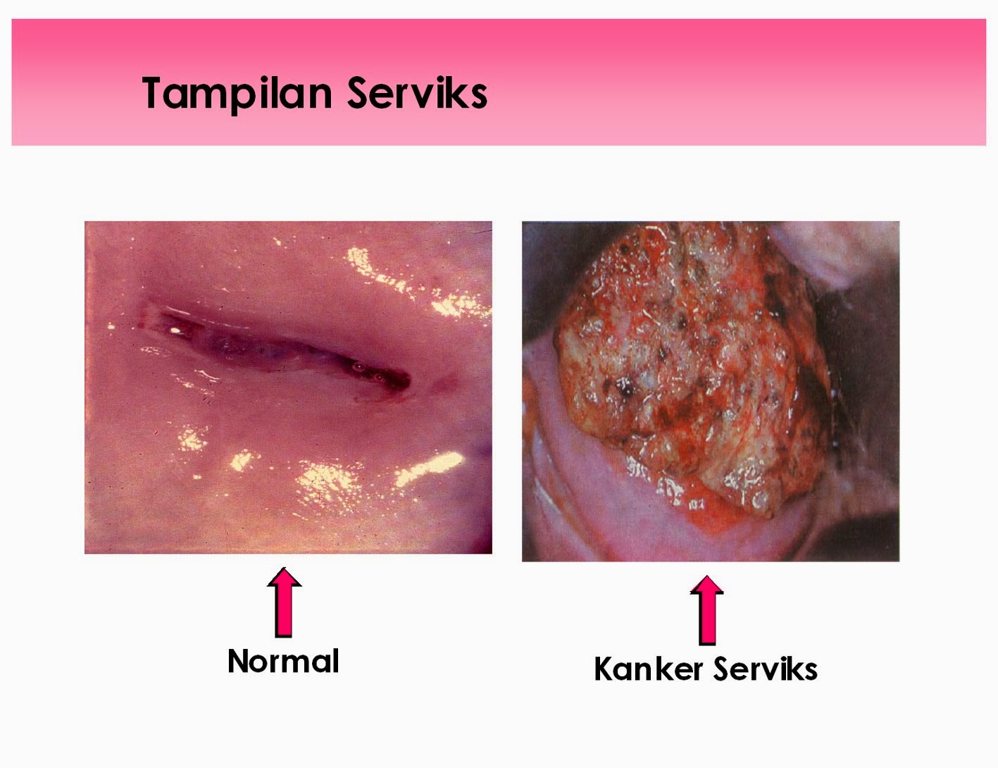 Penyebab Kanker  Serviks  atau Kanker  Leher Rahim 