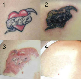 Tattoo Removal: Cream Removal
