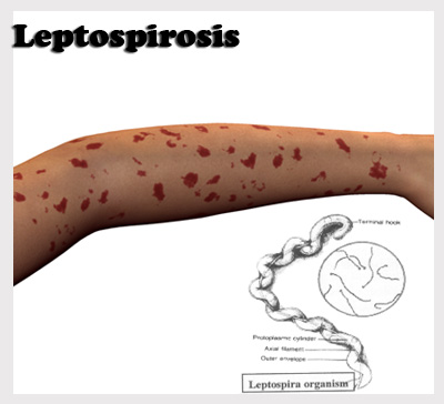 Leptospirosis