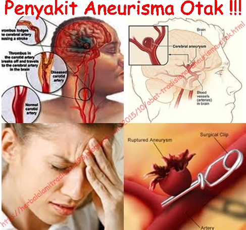 Obat Tradisional Aneurisma Otak