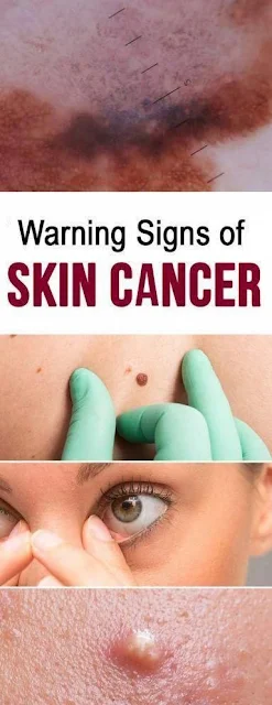 Skin Cancer Warning Signs