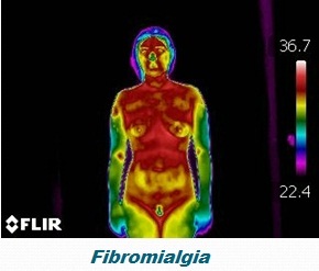 Fibromialgia: abordagem holística, artigo de Frederico Lobo - Termografia
