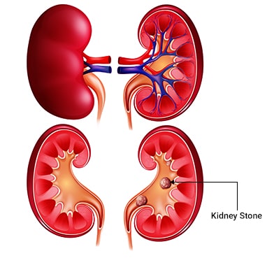 Kidney Stone Surgery in Delhi, Kidney Stone Surgery cost in Delhi