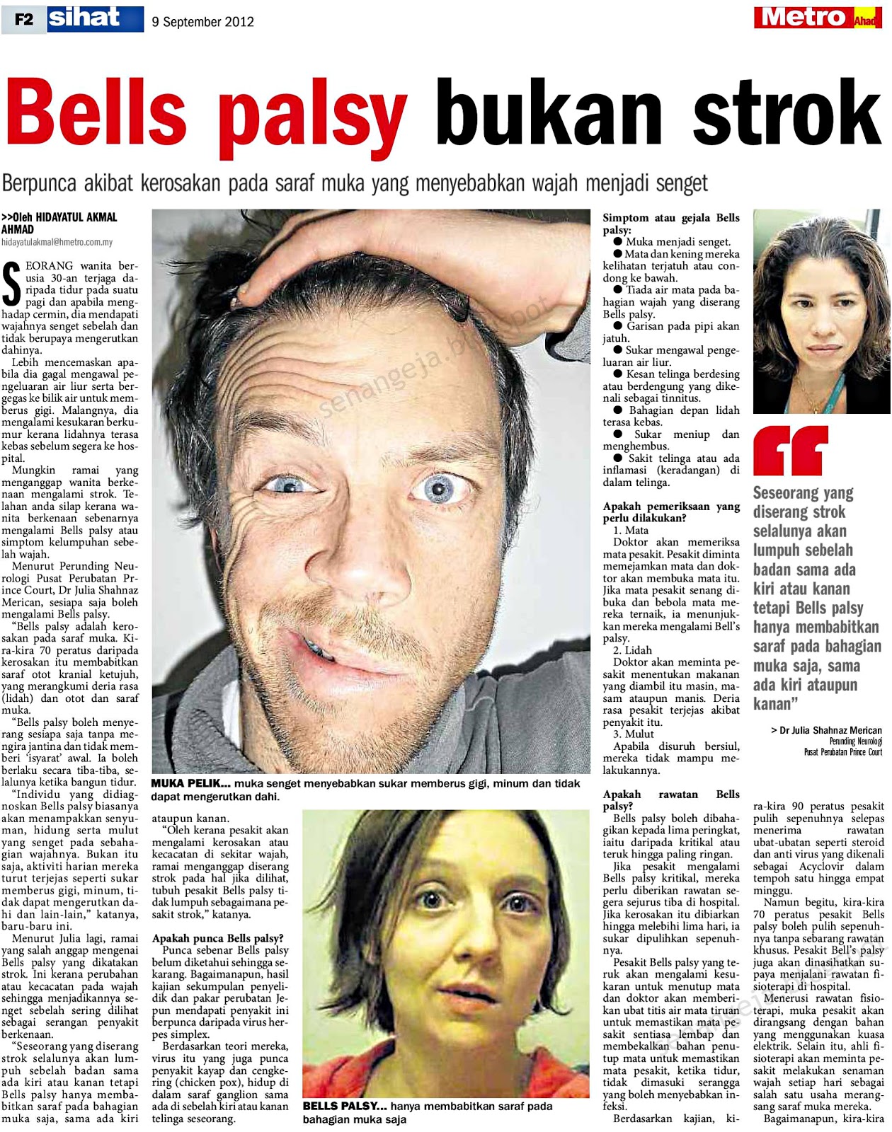 Muka Herot : Bell Palsy atau Strok