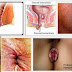 Benjolan Di Anus Terasa Gatal thumbnail