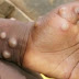 Viruela del mono y viruela humana: estas son las similitudes y diferencias