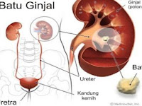 Gejala batu ginjal pada wanita