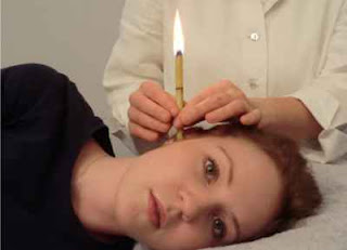 praktek penggunaan ear candle