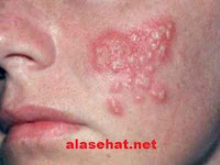 Cara Mengobati Herpes Dengan Bahan Alami